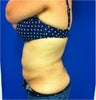 Laser Liposuction