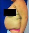 Laser Liposuction