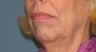 Thermage full face and neck