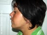 Vaser Lipo + Thread Lift to Eliminate Double Chin