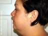 Vaser Lipo + Thread Lift to Eliminate Double Chin