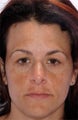 Chemical Peel