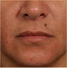 44 year old female with deep parenthesis lines and thinning lips