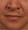 44 year old female with deep parenthesis lines and thinning lips