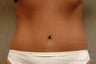 Tummy Tuck Revision Patient