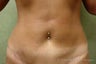 Tummy Tuck Revision Patient