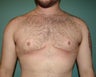 FTM "Top Surgery" for chest masculinization