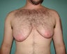 FTM "Top Surgery" for chest masculinization