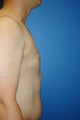 Gynecomastia procedure