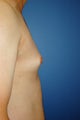 Gynecomastia procedure