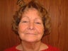 72 year old woman has Phenol Peel