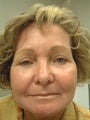 72 year old woman has Phenol Peel