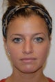 Non surgical Rhinoplasty in an 24 year old female