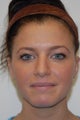 Non surgical Rhinoplasty in an 24 year old female