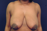 Breast Lift
