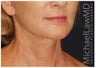 Facelift