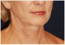 Facelift