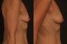 Fat Transfer Breast Enhancement