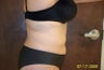 34 Year Old Femal Treated with Smartlipo