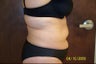 34 Year Old Femal Treated with Smartlipo