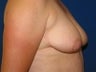 Breast Lift