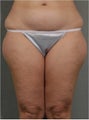 43 year old female would like more contouring in her thighs and waistline