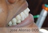 Female Patient with missing teeth on upper and lower, Dental Bridges placed