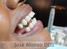 Female Patient with missing teeth on upper and lower, Dental Bridges placed