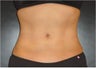 SmartLipo MPX with PRO-Sculpt