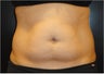 SmartLipo MPX with PRO-Sculpt