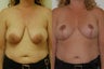 Breast Lift
