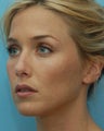Cheek Augmentation Using Restylane