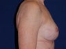Breast Reconstruction