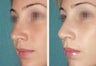 Female Revision Rhinoplasty