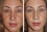 Female Revision Rhinoplasty