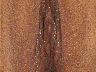 Vaginoplasty