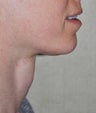 35 Year Old Female Treated For Prominent Adam's Apple