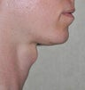 35 Year Old Female Treated For Prominent Adam's Apple