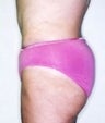 Female patient who underwent a thigh lift