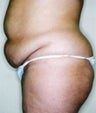 Female patient who underwent a thigh lift