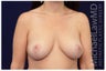 Breast Lift