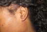 earlobe keloid excision and reconstruction