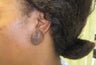 earlobe keloid excision and reconstruction
