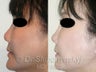Asian Revision Rhinoplasty – Pollybeak Deformity