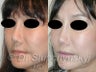 Asian Revision Rhinoplasty – Pollybeak Deformity