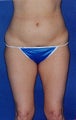 liposuction body