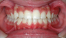 Invisalign Teen: 13 Year Old Treated for Underbite and Severe Crowding