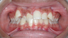 Invisalign Teen: 13 Year Old Treated for Underbite and Severe Crowding