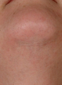 Laser Hair Removal