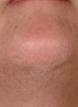 Laser Hair Removal